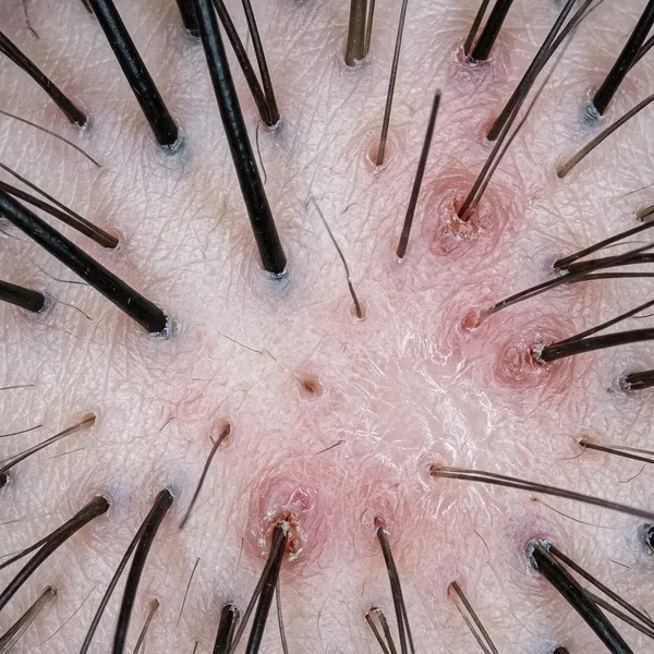 what kills hair follicles